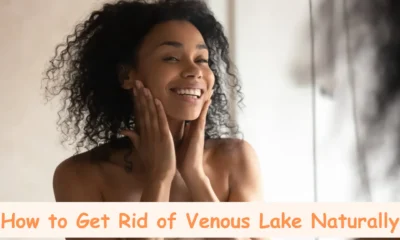 How to Get Rid of Venous Lake Naturally